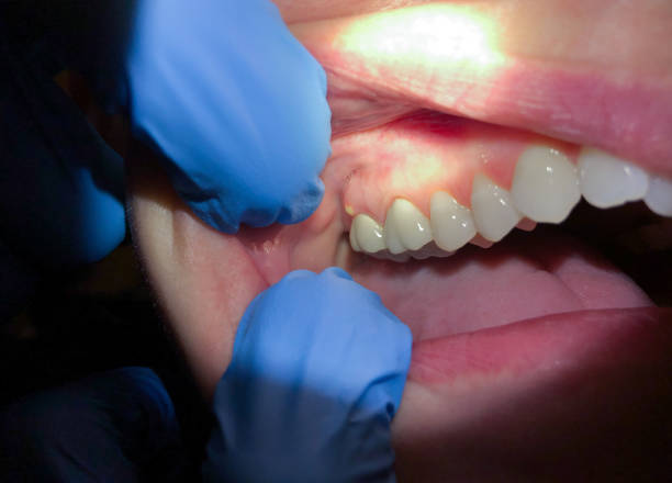 Best Emergency Dental Extractions in Hurt, VA